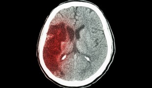 35% of Americans Adults May Have Had a Warning Stroke